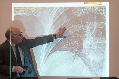 Dr. Wendell Gibby points to rib fractures on Terry Sanderson's X-rays on Wednesday, March 22, 2023, in Park City, Utah. Gibby testified in support of Sanderson's lawsuit blaming actor Gwyneth Paltrow for the crash.