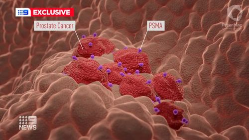 The world's first trial is investigating a new approach to fighting prostate cancer in men with advanced disease. 