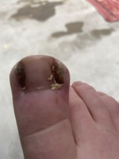 Woman's daughter gets ingrown toenail infected and finds maggots growing on it.