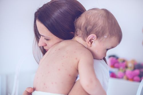 Symptoms of measles include fever, sore eyes and a cough followed by a red, blotchy rash. (Getty)