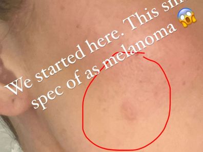 Khloe Kardashian's melanoma scare 