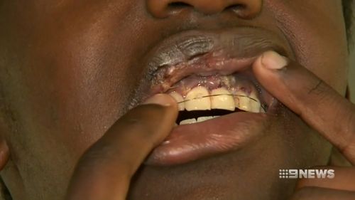 Ngor may have to get veneers due to the long-term damage.