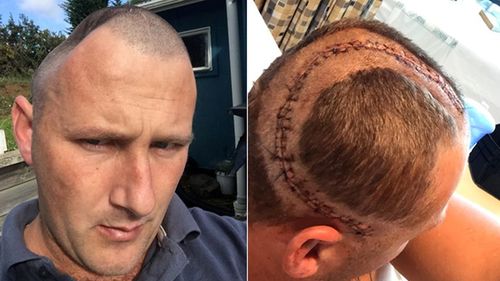 Benjamin Lightbody has endured five operations to replace a large piece of his skull with an implant. Because of the implant's size, he has suffered a variety of complications and ongoing pain.