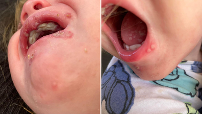 Mum warns parents 'Do not kiss babies' after daughter's shocking cold sore outbreak