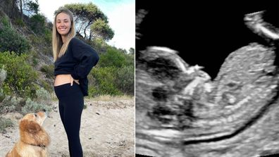 Aussie model Brooke Hogan has announced her pregnancy after a two-year IVF journey