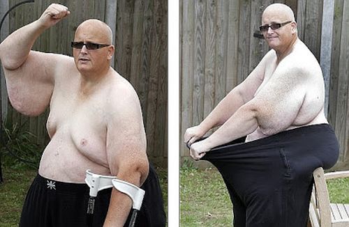 World's fattest man awaits US trip for life-saving skin surgery