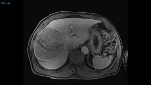 Mater surgeon removes huge 2kg tumour from man's liver
