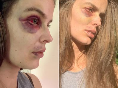 Australian model Robyn Lawley pictured following a recent seizure