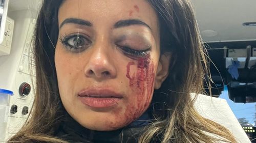 Images show Hannah bruised with a bloodied eye.﻿