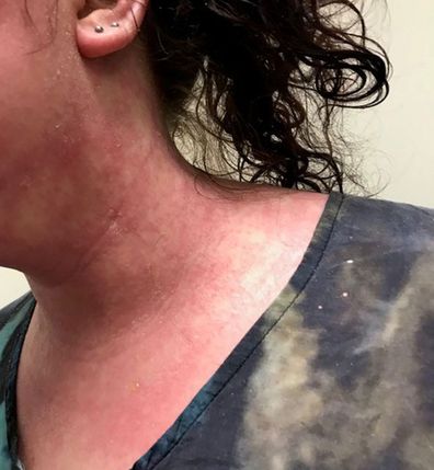 Kiara Adoranti said her severe eczema has affected every part of her life, and she's even unable to work.