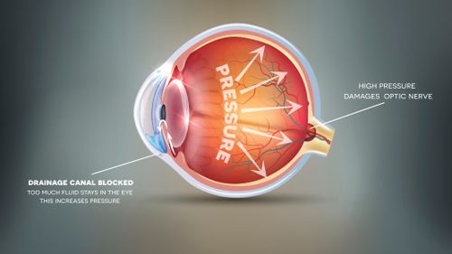 The new study could be a medical breakthrough for the disease, which causes blindness. (iStock)