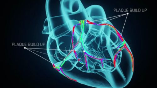 It's hoped the mapping will help provide at-risk people with an estimate of when a heart attack could strike. (9NEWS)