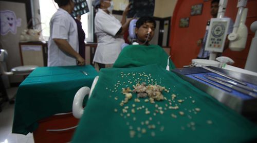 Mouthful: Teen has record 232 teeth extracted from his mouth