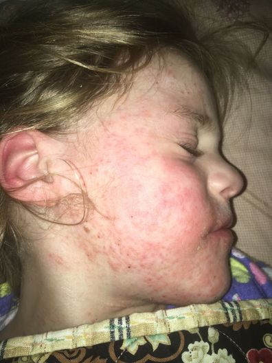 Sophie Gray broke out in itchy rashes that her mum thought were just eczema.