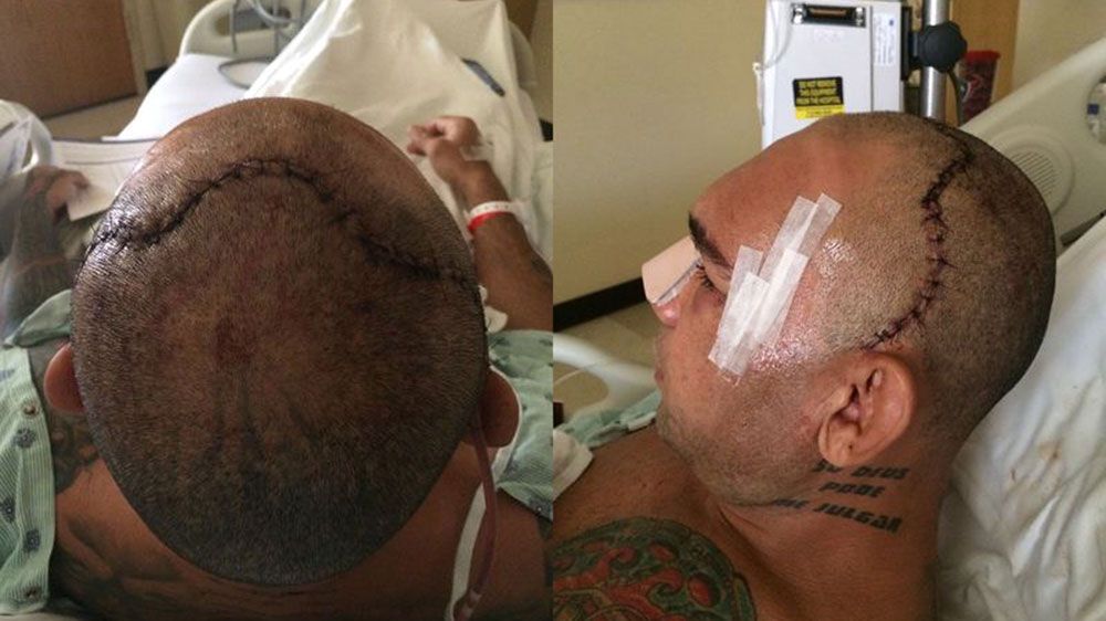 Evangelista Santos before his surgery, left, to fix his cracked skull and after (MMA Fighting)