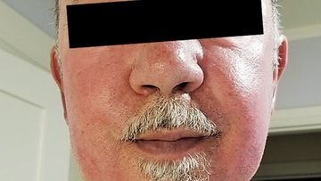 The man, aged 75, went to a dermatology clinic with erythema of the face, which doctors later found was linked to his pacemaker.