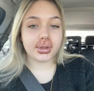 Jade lip flip results