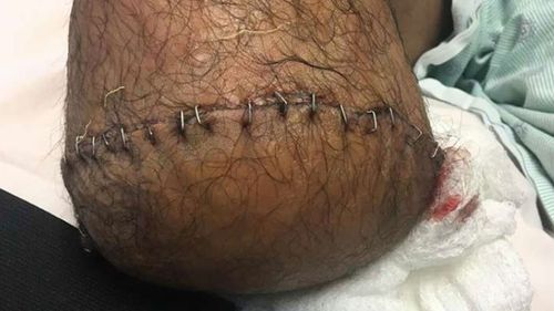 The 26-year-old's foot was amputated when doctors realised the flesh-eating bacteria threatened his life. 