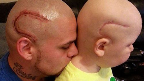 US father gets head tattooed to mimic son’s cancer scar