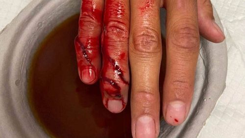 Kiwi surfer Tai Juneau had surgery to repair the tendon.