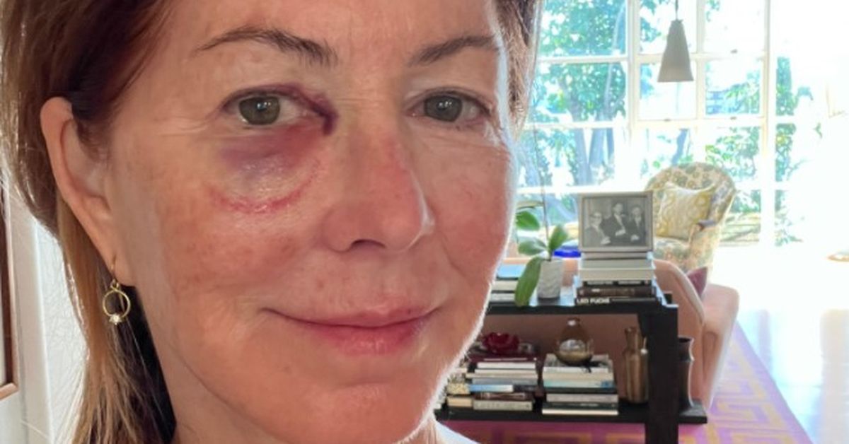 Actress Dana Delany shares photo of bruised eye after falling down