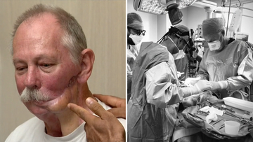 When John Manwaring lost a jawbone to cancer two years ago he never expected to become part of a world-first medical marvel.