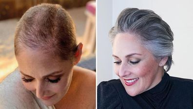Former TV host Ricki Lake shares one-year hair growth after battle with alopecia.