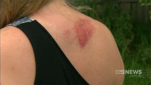 Ms Kinna suffered bruising and injuries on her back. (9 NEWS)