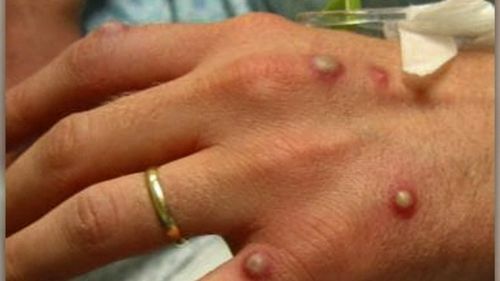 The monkeypox virus is spreading in Melbourne in the first widespread example of local transmission since the global outbreak began.