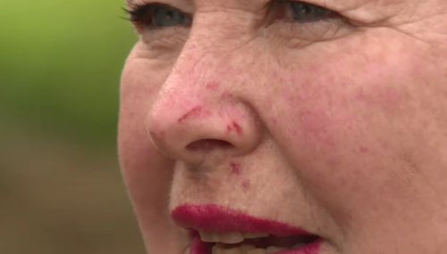 Ms Killeen suffered some cuts to her face courtesy of the pelican. (9NEWS)