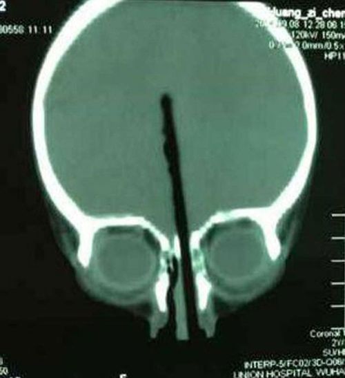 An X-ray showed the chopstick lodged 7cm in the brain of the toddler, who is expected to make a full recovery. (Supplied)