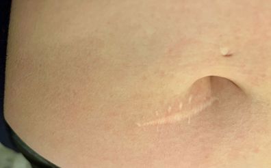 The scar on Madelaine Wigham's stomach where the melanoma was cut out.