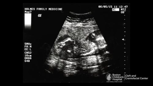 An ultrasound of Bentley in the womb. (Boston Children's Hospital)