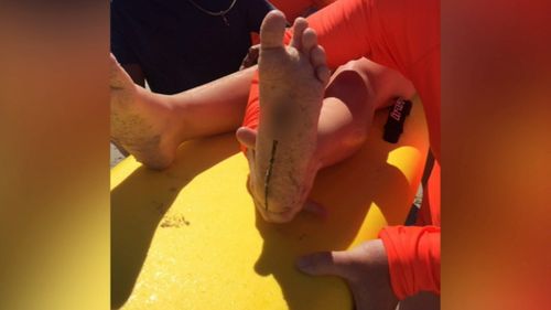 Locals are calling for urgent action as children keep getting injured by the barbs hidden throughout the sand at West Beach.