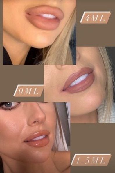 Love Island UK Faye Winter gets lip filler dissolved. 