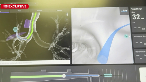 Revolutionary robot, called 'ION', to improve lung cancer early detection