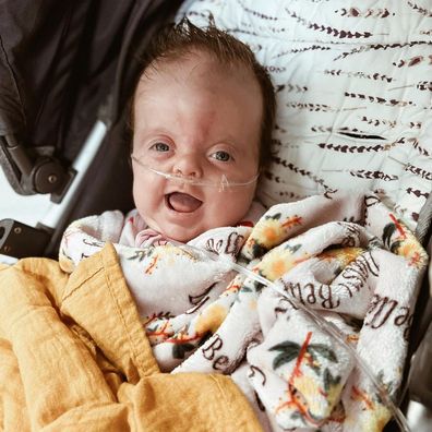 Mum Debb is sharing her story to raise awareness about Apert Syndrome