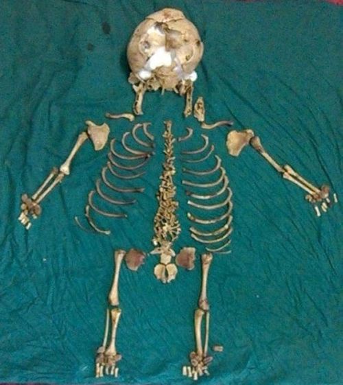 Doctors describe discovery of foetus skeleton inside woman for 36 years as ‘medical marvel’