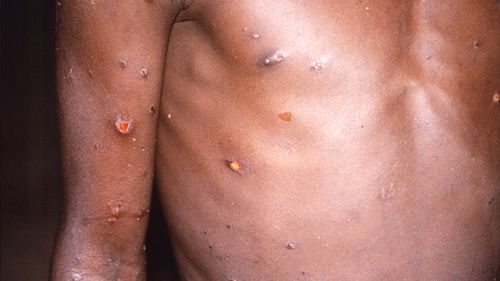 This image shows the right arm and torso of a patient, whose skin displayed a number of lesions due to what had been an active case of monkeypox.