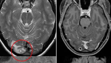 What doctors thought was a cyst in the Melbourne woman&#x27;s brain turned out to be a clump of parasite larvae.
