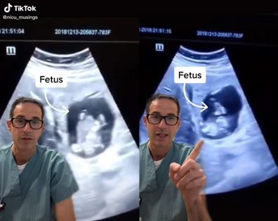 Doctor on TikTok showing ultrasound of ectopic pregnancy in liver. 