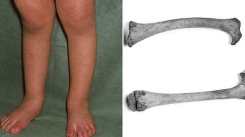 Rickets is a preventable disease that occurs in children and impacts the bones of their legs. Pictured are stock images of children suffering rickets. (Getty)