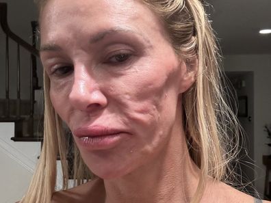 Brandi Glanville face disfigurement