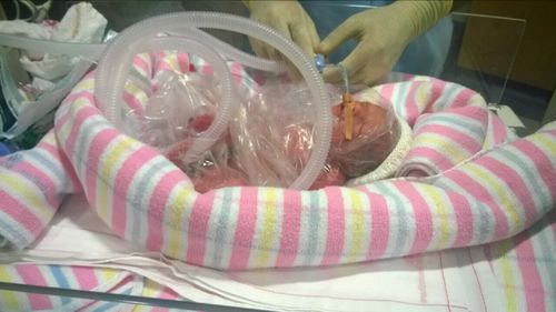 Estelle was born at 26 weeks due to a complication in pregnancy called placenta percreta. (Supplied)
