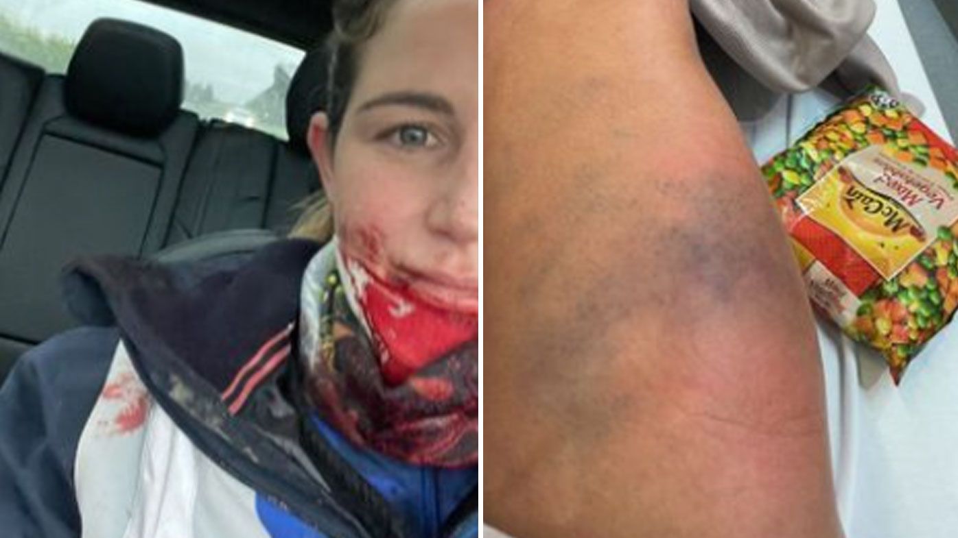Michelle Payne posted her injuries to Instagram after being kicked in the face by a horse. 