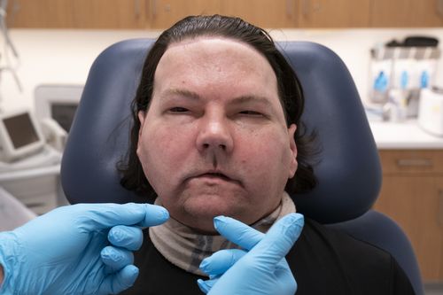 oftly, Monday, Jan. 25, 2021 at NYU Langone Health in New York, six months after an extremely rare double hand and face transplant. During the medical checkup, he practiced raising his eyebrows, opening and closing his eyes, puckering his mouth, giving a thumbs up and whistling. (AP Photo/Mark Lennihan)