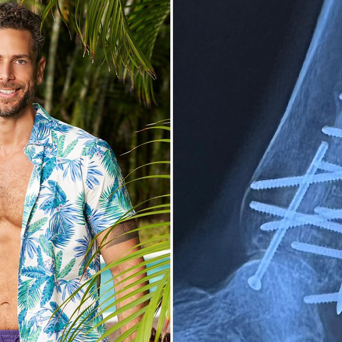 Bachelor in Paradise's Casey Says He Hasn't Walked in 4 Months