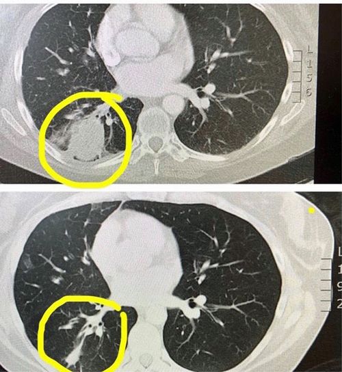 CT scans from Gold Coast University Hospital show the appear to show a significant reduction in the tumour in Ms Malvenan's lung.  