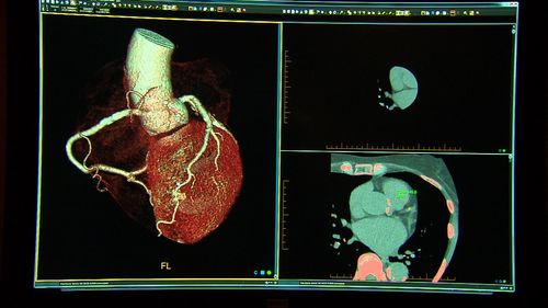 The 15-minute test could rule out if a person is having a heart attack.