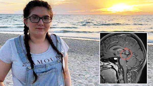 South Australian teen Amelia Hocking needs lifesaving surgery to remove a cyst from her brain. (Supplied)